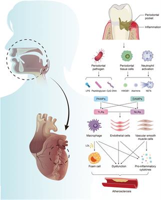 <mark class="highlighted">PAMPs and DAMPs</mark> as the Bridge Between Periodontitis and Atherosclerosis: The Potential Therapeutic Targets